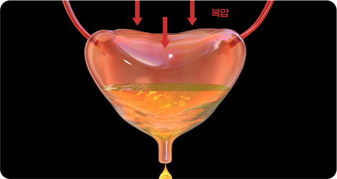 복압성 요실금 이미지