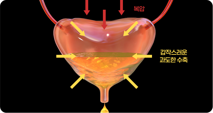 혼합성 요실금 이미지