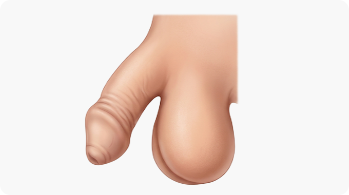 포경수술 전 이미지