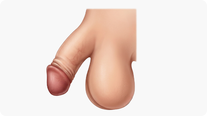 포경수술 후 이미지