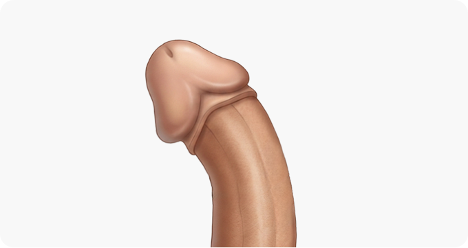 음경만곡증 상태의 음경 이미지