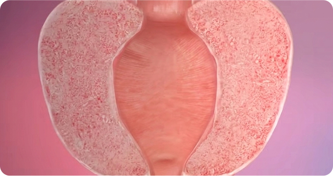 로봇 전립선절제술 수술 STEP 04