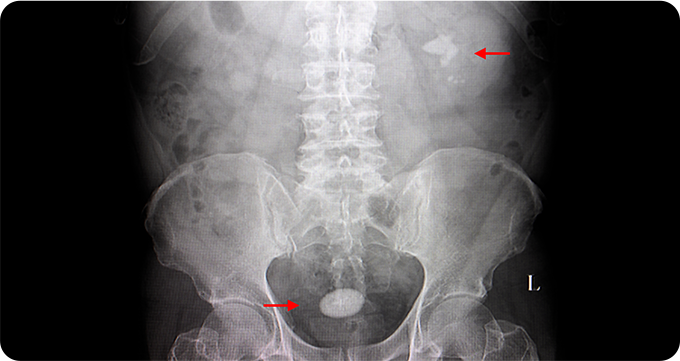 단순 요로 X-ray 이미지