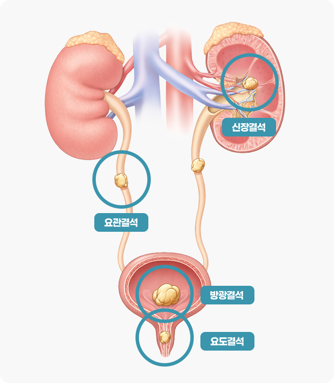 요로결석 상태의 요로 이미지